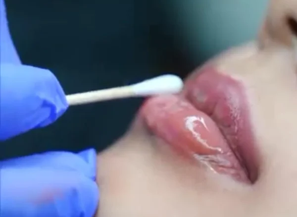 Lip Pigmentation Lip Pigmentation