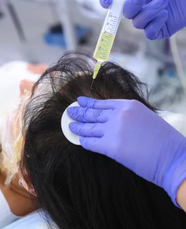 PRP Therapy for Hair Loss PRP Therapy for Hair Loss