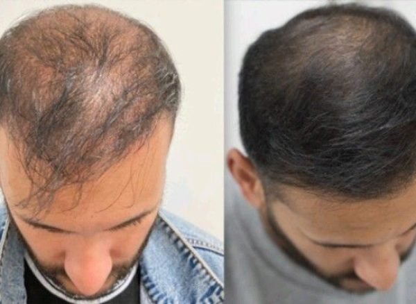 hair transplant