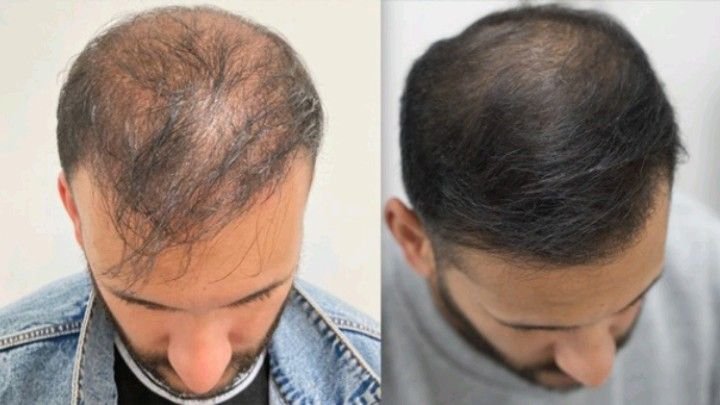 hair transplant
