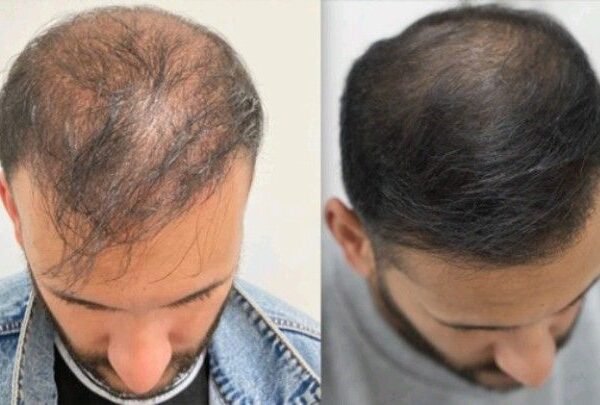 Top 5 Foods for Hair Growth Nourish Your Locks From Within With These Hair-Healthy Foods hair growth treatment