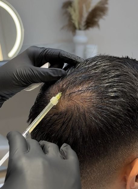 best prp treatment in trivandrum